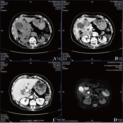 Primary Hepatoid Adenocarcinoma of Gallbladder With MB21D2/GALNT12/ARID2 Mutations: A Case Report